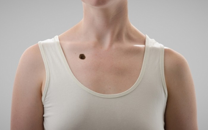 Καρκίνος δέρματος