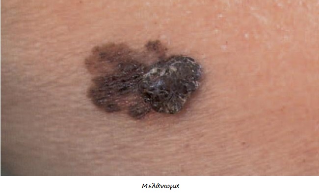 Καρκίνος δέρματος