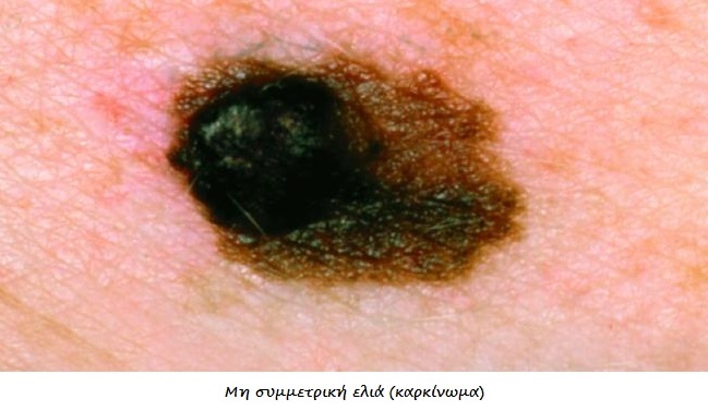 Καρκίνος δέρματος