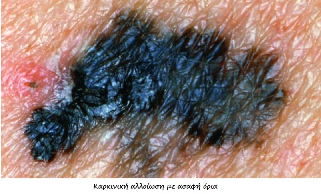 Καρκίνος δέρματος