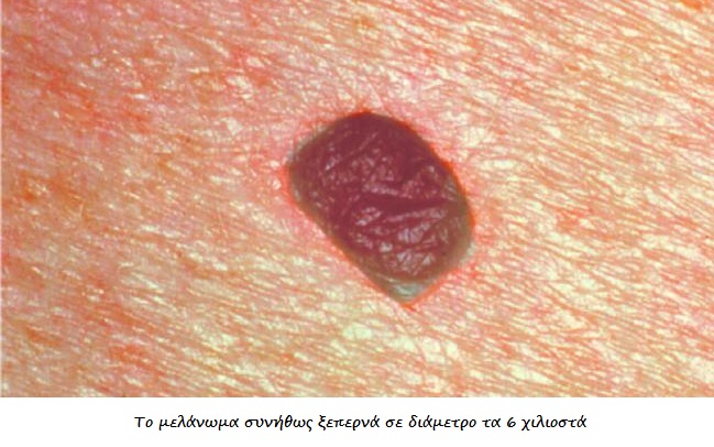 Καρκίνος δέρματος