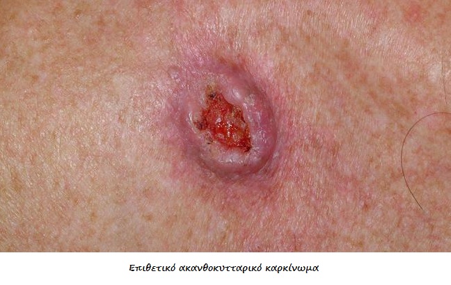 Καρκίνος δέρματος