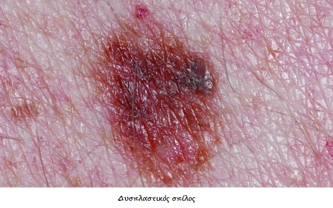 Καρκίνος δέρματος