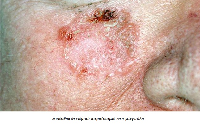 Καρκίνος δέρματος