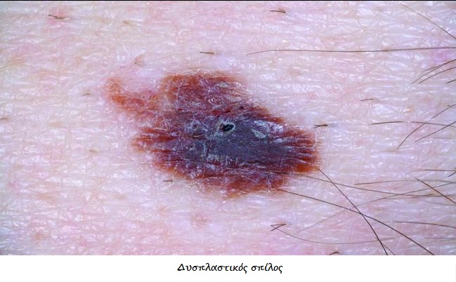 Καρκίνος δέρματος