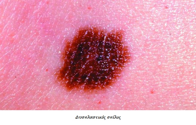 Καρκίνος δέρματος