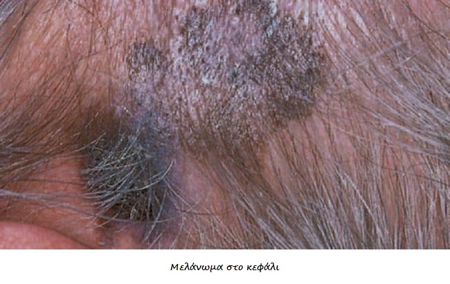 Καρκίνος δέρματος