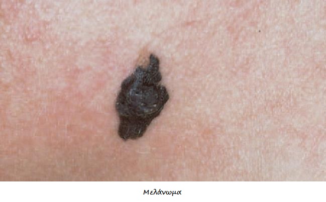 Καρκίνος δέρματος