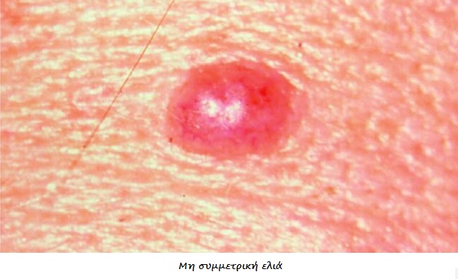 Καρκίνος δέρματος