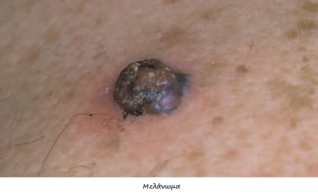 Καρκίνος δέρματος