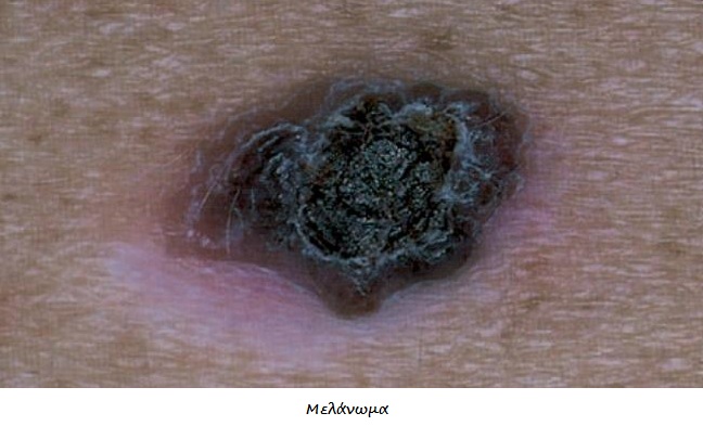 Καρκίνος δέρματος