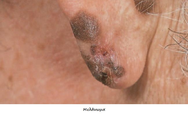 Καρκίνος δέρματος