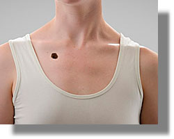 Καρκίνος δέρματος