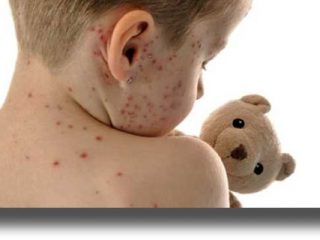 Διαστάσεις επιδημίας για την ιλαρά στην Ευρώπη