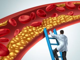 Στένωση αρτηριών: Τι να τρώτε και τι να αποφεύγετε