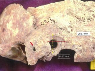 Θάσος: Ανακαλύφθηκε κρανίο πρωτοβυζαντινής περιόδου με ενδείξεις «απίστευτα» πολύπλοκης χειρουργικής επέμβασης