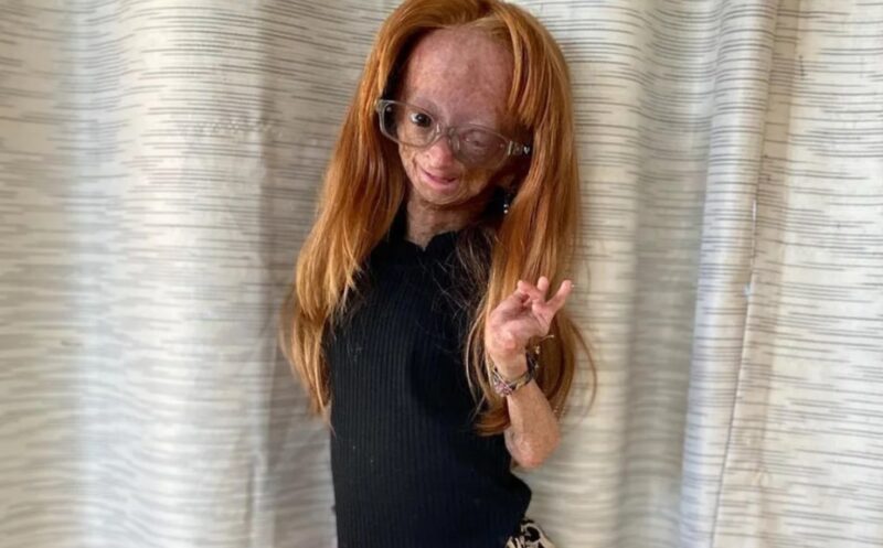 Πέθανε σε ηλικία 15 ετών η σταρ του YouTube που έπασχε από τη νόσο Benjamin Button